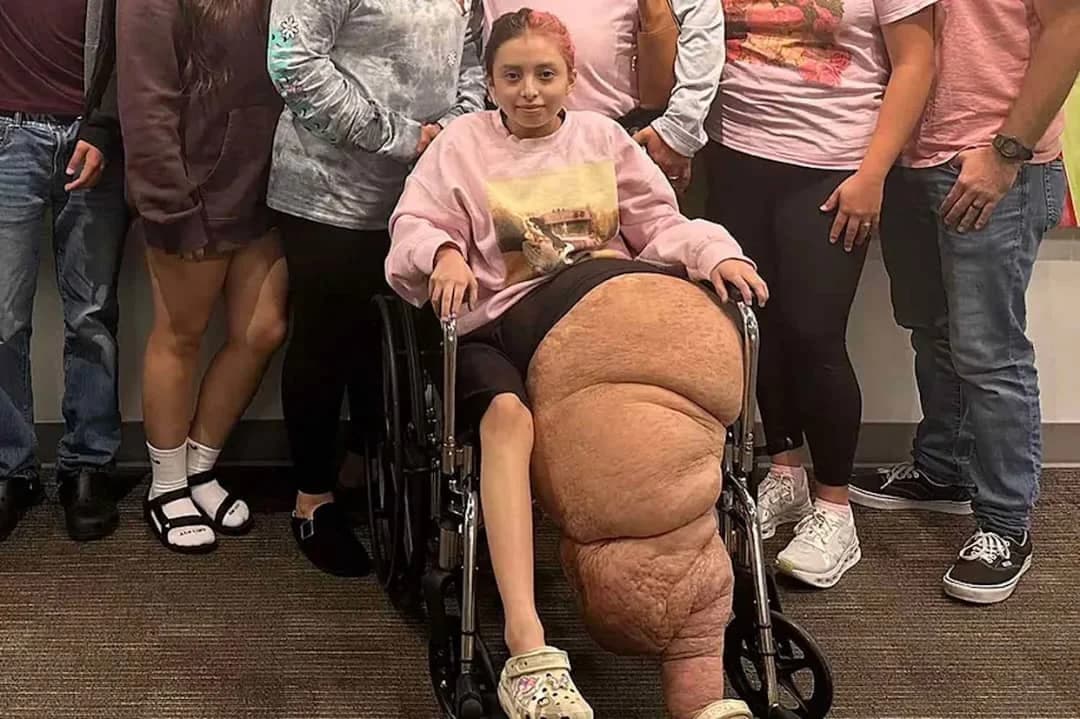 Florida Teen undergoes marathon surgery to remove 174-Lb. leg: ‘She is so strong’