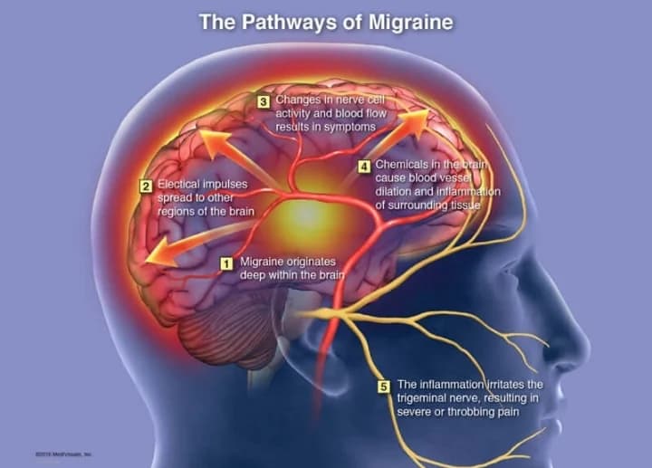 Ibyo wamenya Ku Ndwara ya Migraine ububabare bukabije bw'Umutwe.