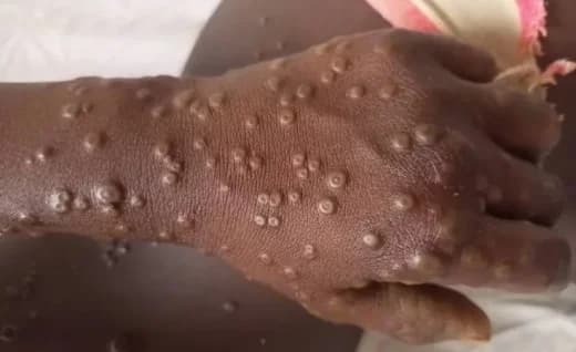 U Rwanda rwiteguye gutsinda Mpox nk'uko rwatsinze ibindi byorezo